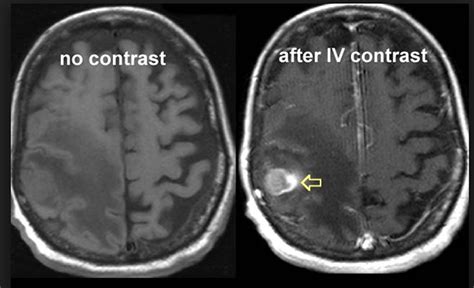 MRIs and contrast gadolinium | Powerful Patient