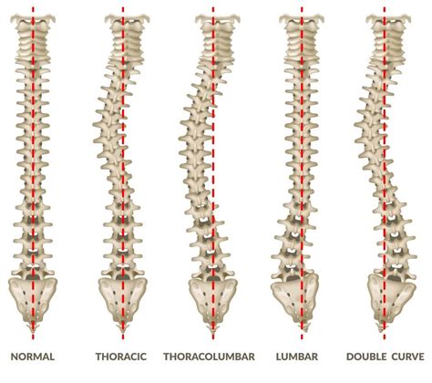 Scoliosis Treatment in Santa Clara | Hoewisch Chiropractic