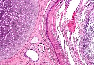 Teratoma - Libre Pathology