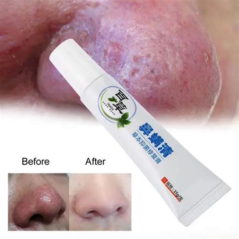 15g Rosacea Treatment Cream Nose Redness Removal Cleaning Antibacterial ...