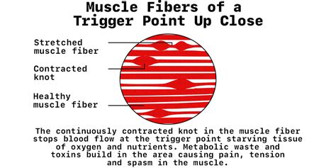 Calf Muscle Knots - All You Need to Know About These Painful Lumps ...