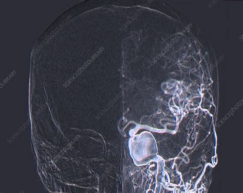 Brain aneurysm, angiogram - Stock Image - C048/0279 - Science Photo Library