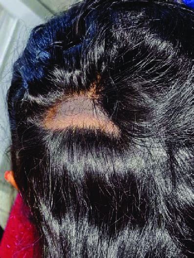 Patient having a patch of complete nonscarring alopecia | Download ...