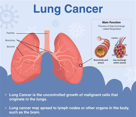 Overview of Lung Cancer: Signs, Symptoms, Diagnosis & Treatment