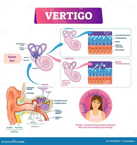 Vertigo Vector Illustration. Labeled Medical Vestibular Ear Problem ...