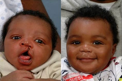 Cleft Palate and Cleft Lip – Causes, Symptoms and Treatment | Healthtian