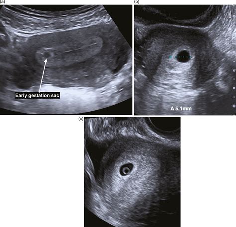 Ectopic Pregnancy Ultrasound