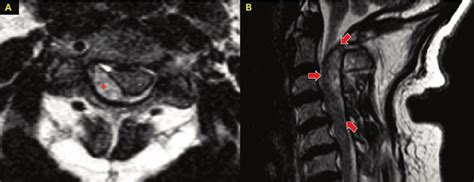 CT-angiogram of the neck and non-contrast CT head. A predominantly ...