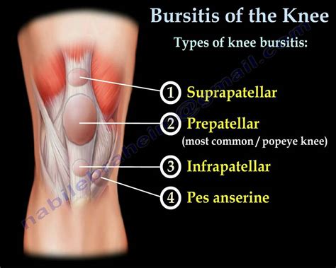 Knee Bursitis,prepatellar bursitis - Everything You Need To Know - Dr ...