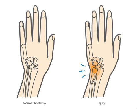 Extensor Carpi Ulnaris Tenosynovitis