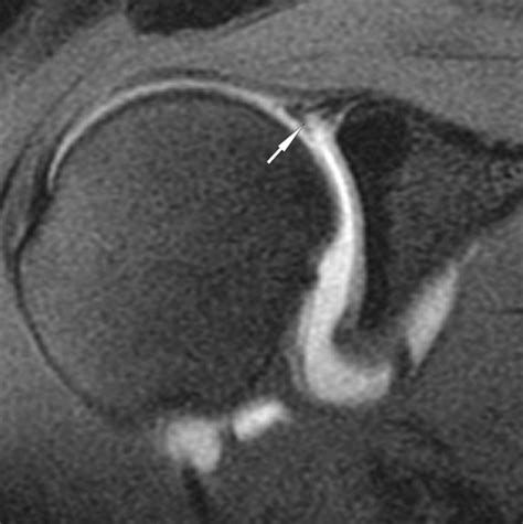 Mri Arthrogram Shoulder Labral Tear