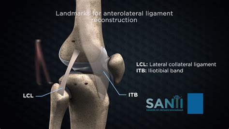 Acl reconstruction - familyharew