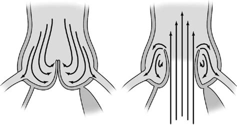 The aortic sinuses form an integral part of the normal aortic valve ...