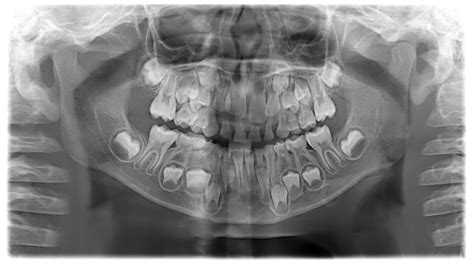 Ankylosed Tooth: What Is It and How Is It Treated? - Ravenscourt Dental ...