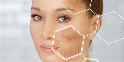 Melasma treatment | Dr Sunil Mishra