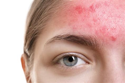 Learn How To Treat Acne Rosacea & Key Differences to Acne