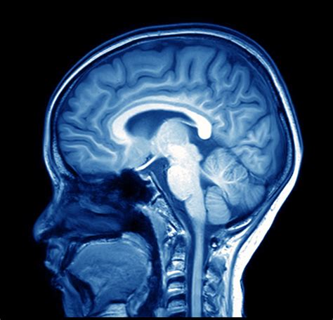 Clinically Silent Brain Lesions Common in Atrial Fibrillation - The ...