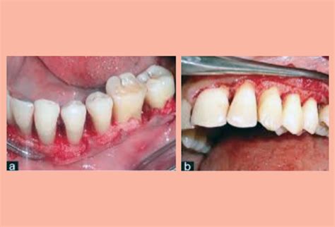 Flap Surgery (Gum Treatment) – Moses