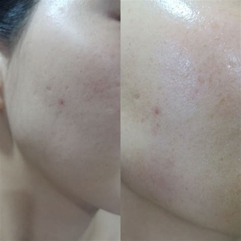 Dr derm skin results with before after pictures – Artofit