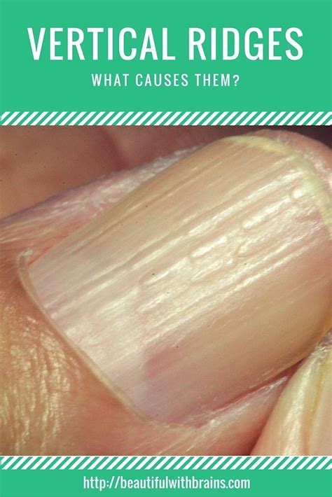 Vertical Lines On Nails - Fingernail Ridges Can Indicate a Thyroid ...