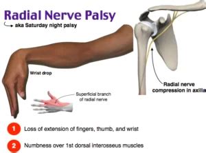 Radial Nerve Injury Cause, Symptom, Physiotherapy Treatment