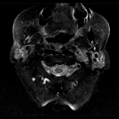 MRI brain with gadolinium contrast; fast spin-echo fat-suppressed T2 ...