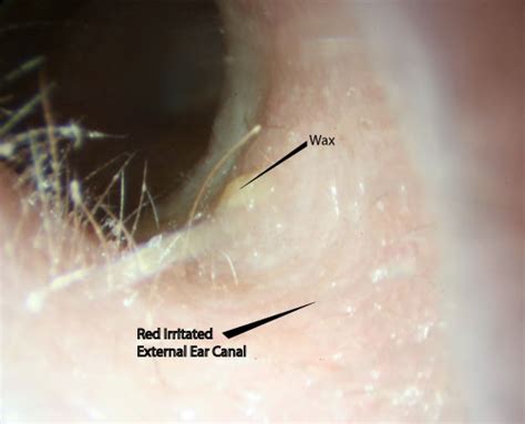 What Causes Your Ears To Itch And Drain - Best Drain Photos Primagem.Org