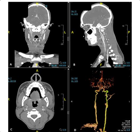 A-C CT angiogram of the head and neck, showing no vascular lesions. D ...