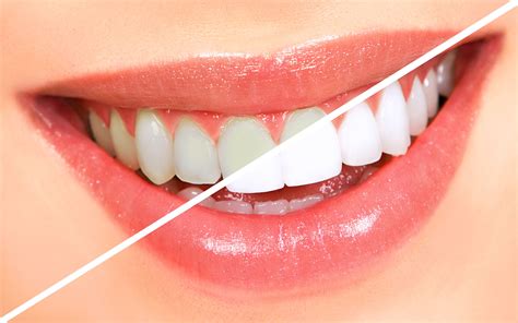 How to Get Whiter Teeth Just In Time for the Holidays