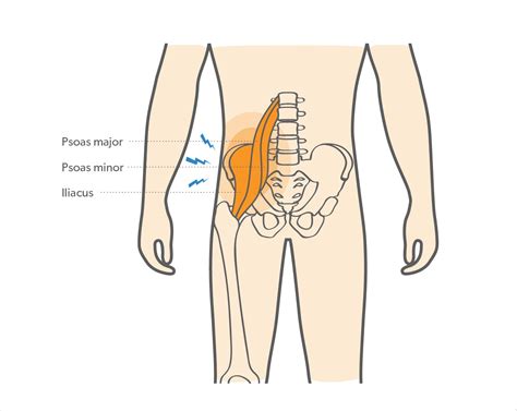 Hip Flexor Pain Causes