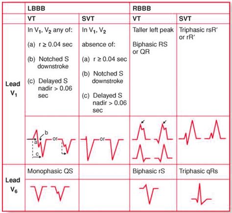 Wide Complex Tachycardia Diagnosis Cardio Guide