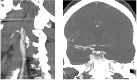 CT Angiogram of the head and neck. Sagittal (left) demonstrates an ...