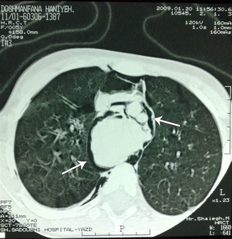 Chest CT scan (HRCT): Mediastinal emphysema. | Download Scientific Diagram