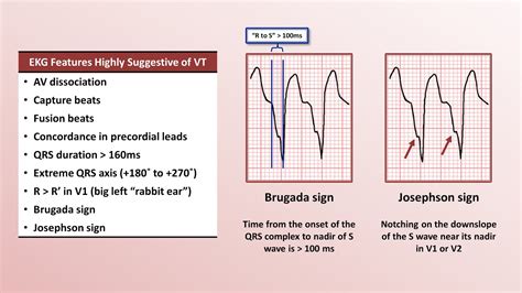 Advanced Ekgs Distinguishing Vt From Svt With Aberrancy Youtube