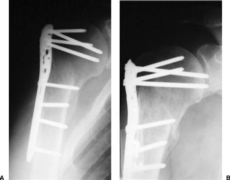 Complications of Proximal Humeral Fractures | Musculoskeletal Key