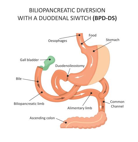 Duodenal Switch Surgery | Lose My Weight and Keep It Off | BMCC