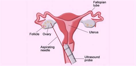 Ovulation Induction - Obstetrics & Gynaecology, Infertility Specialist ...