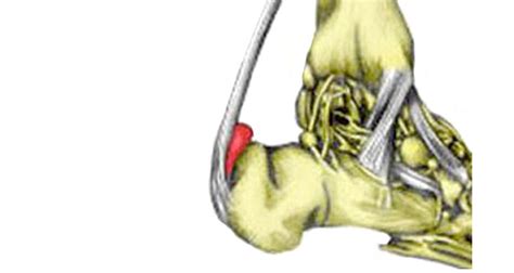 Achilles Bursitis | Retrocalcaneal Bursitis - Symptoms, Causes & Treatment