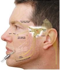 Trigeminal Neuralgia Treatment, Symptoms, What is, Surgery, Causes