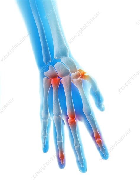 Human hand joints, illustration - Stock Image - F011/0481 - Science ...