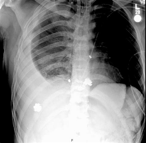 Chest X-ray taken in the trauma bay showing bullet shrapnel overlying... | Download Scientific ...