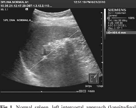 Figure 4 from The ultrasound examination of the spleen. | Semantic Scholar