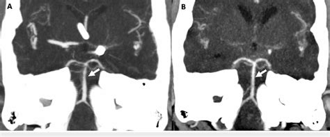 CT angiogram head Coronal MIP CT angiogram image (Figure 2A) shows ...