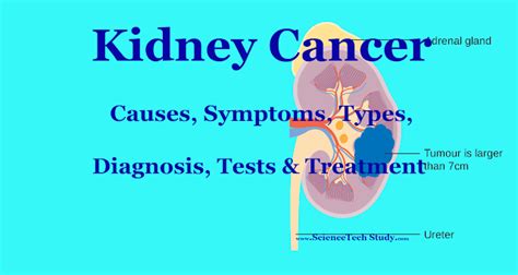 Kidney cancer: Symptoms, Causes, Diagnosis and Treatment