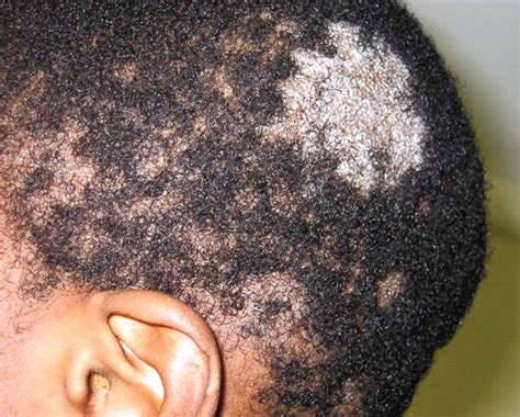 Tinea capitis scalp, causes, symptoms, diagnosis & tinea capitis treatment