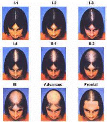 Receding Hairline in Men & Women: Causes, Signs, and Treatment