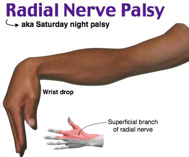 Radial Nerve Palsy Causes