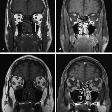 (PDF) Diagnosis and differential diagnosis of Graves' orbitopathy in MRI