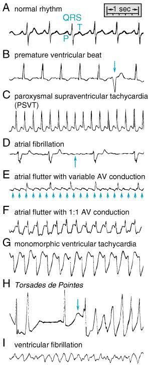 Ventricular Flutter Vs Torsades