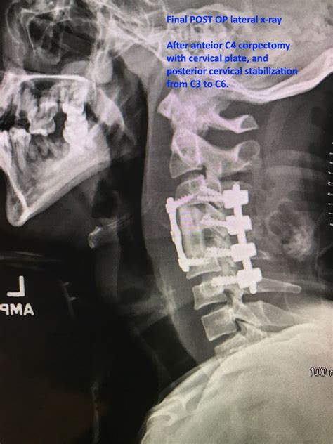 Complex Cervical Spine Surgery – Matthew Lawson, M.D.